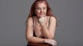 Renowned Makeup Artist Isabella Schimid On Her Journey With Vitiligo